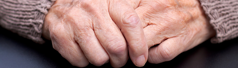 rheumatoid arthritis inflammation control